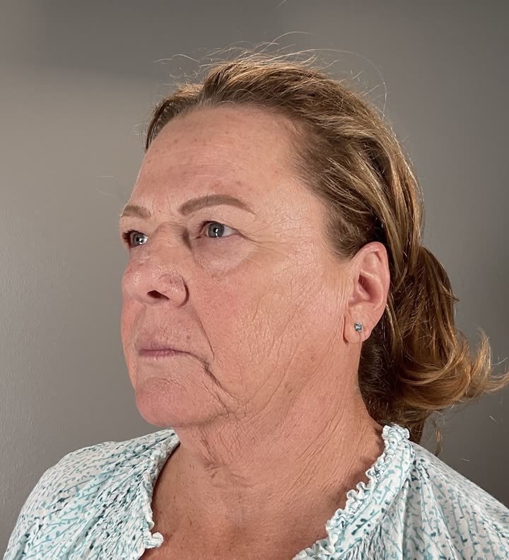 LeeLift patient before